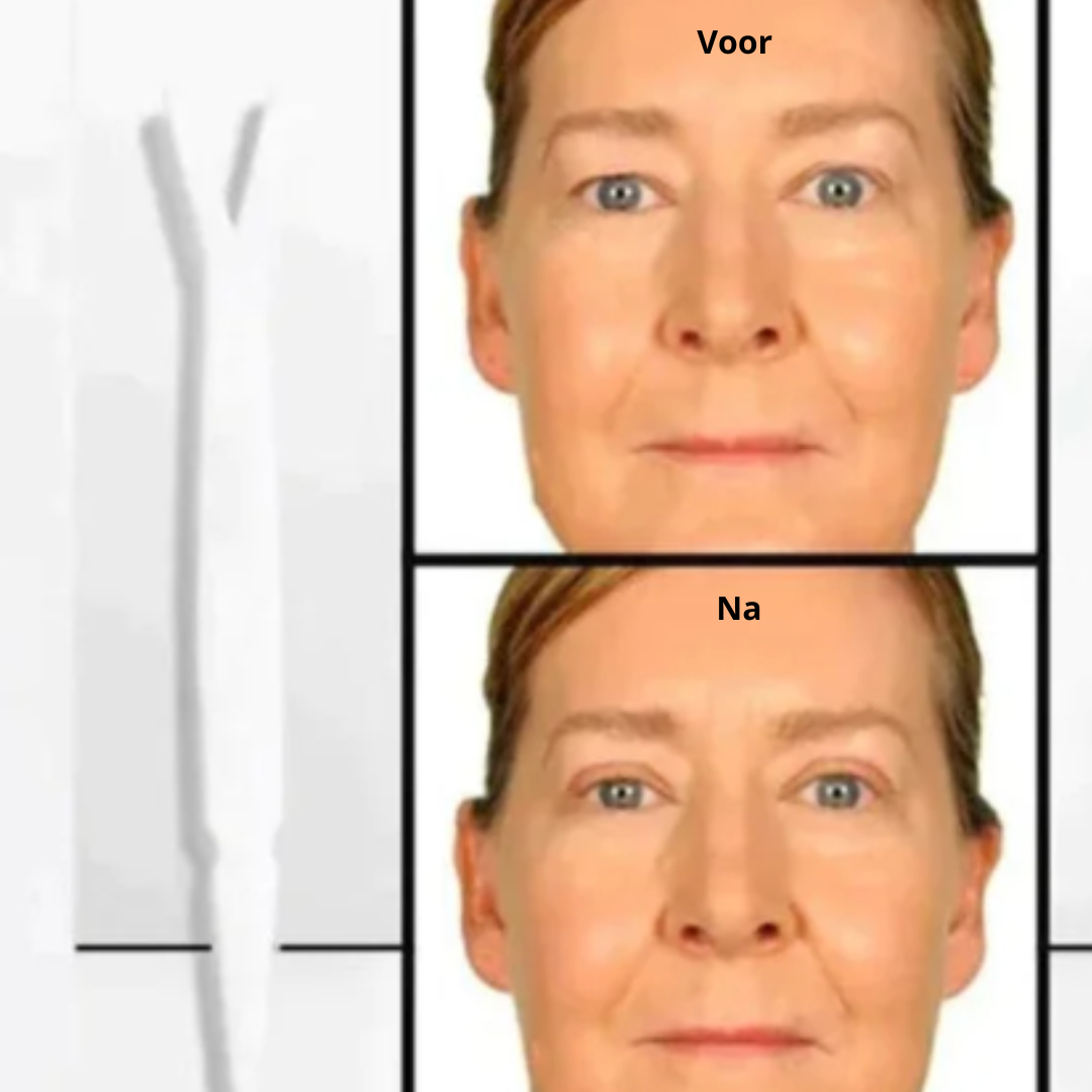 GlamLids I Directe Ooglidcorrectie Zonder Chirurgie